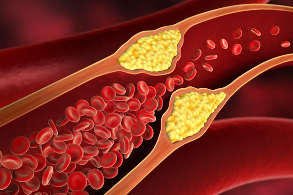 ⁠High Cholesterol